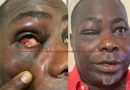 I Did Not Bite MP Mireku’s Finger —  Charles Bissue Speaks After Bloody Punches