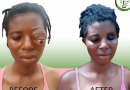 I Wanted To End My Life — Eye Tumor Patient Reveals